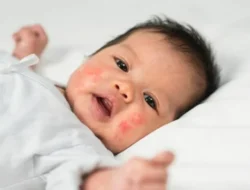 Cek Penyebab dan Jenis Biang Keringat pada Bayi Biar Gak Panik Lagi