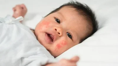 Cek Penyebab dan Jenis Biang Keringat pada Bayi Biar Gak Panik Lagi