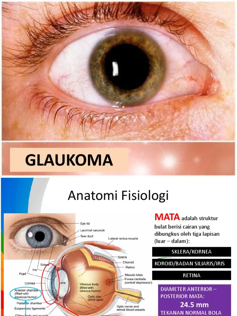 Kenali Jenis-Jenis Glaukoma Sebelum Terlambat