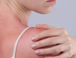 Reminder Mama Muda! Kulit Anak Mengelupas karena Sunburn Ada Risikonya, Yuk Sat Set Dicegah