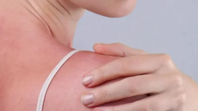 Reminder Mama Muda! Kulit Anak Mengelupas karena Sunburn Ada Risikonya, Yuk Sat Set Dicegah