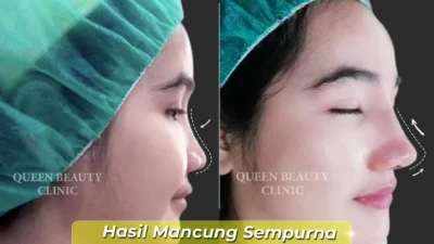 Rina Nose Tampil dengan Hidung Baru Usai Operasi Plastik di Indonesia, Tren Rhinoplasty Selebriti Meningkat