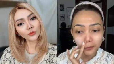 Rina Nose Ungkap Alasan Pilih Operasi Plastik Bersama Dr. Tompi
