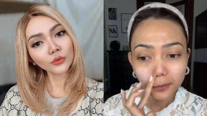 Rina Nose Ungkap Alasan Pilih Operasi Plastik Bersama Dr. Tompi