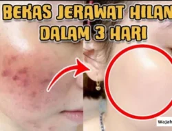 Menghilangkan Bekas Jerawat dengan Deretan Ingredients yang Cocok untuk Menghilangkan Bekas Jerawat
