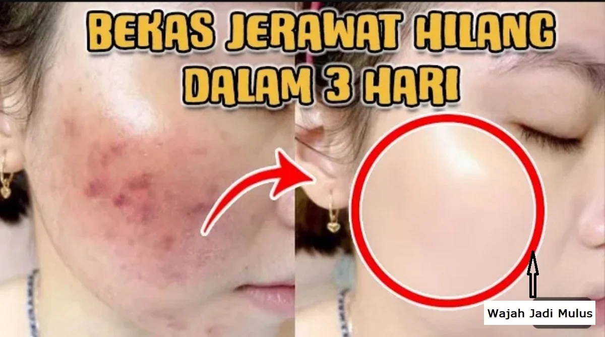 Menghilangkan Bekas Jerawat dengan Deretan Ingredients yang Cocok untuk Menghilangkan Bekas Jerawat